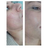 limpeza de pele com acne valor Bela Vista