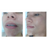limpeza de pele com acne Vila Mariana