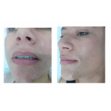 limpeza de pele com acne Bela Cintra