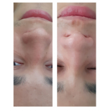 limpeza de pele facial preços Bela Cintra