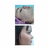 limpeza de pele facial valor Praça Da Árvore