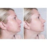 limpeza de pele facial Saúde