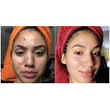 Limpeza de Pele Acne