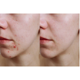 limpeza de pele para cicatrizes de acne preços Ana Rosa