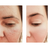 limpeza de pele para cicatrizes de acne valor Consolação