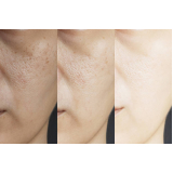 limpeza de pele para cicatrizes de acne Vila Mariana