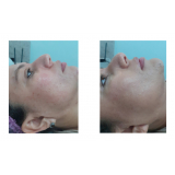 limpeza de pele para poros dilatados preços Ana Rosa