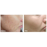 limpezas de pele acne Consolação