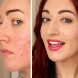 onde encontrar limpeza de pele acne Consolação