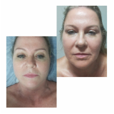 onde faz rejuvenescimento facial natural Bela Cintra