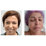 onde faz rejuvenescimento natural facial Vila Mariana