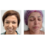 onde faz rejuvenescimento natural facial Saúde