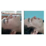 onde fazer limpeza de pele facial Saúde