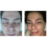 onde fazer rejuvenescimento natural facial Bela Vista