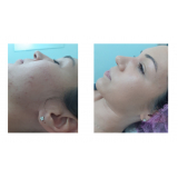 onde fazer tratamento cicatriz acne Bela Vista