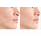 onde fazer tratamento contra acne Higienópolis