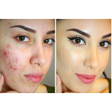 peeling para acne barato Saúde