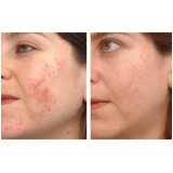 peeling para acne Saúde