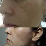 peeling para clarear manchas barato Consolação