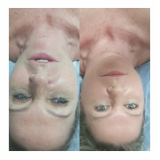 rejuvenescimento facial natural Saúde