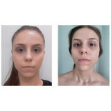rejuvenescimento natural facial preço Chácara Klabin