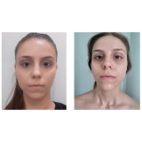 rejuvenescimento natural facial preço Jardim Paulista