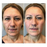 rejuvenescimento para blefaroplastia valores Chácara Klabin