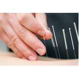 serviço de acupuntura para dores musculares Bela Vista