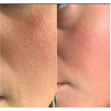 serviço de limpeza de pele com acne Bela Cintra