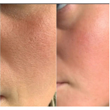 serviço de limpeza de pele com acne Saúde