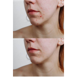 serviço de limpeza de pele para cicatrizes de acne Consolação
