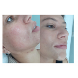 serviço de limpeza de pele para poros dilatados Saúde