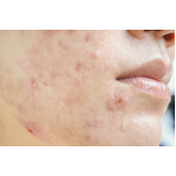 tratamento a laser para acne agendar Chácara Klabin
