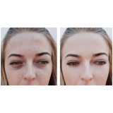 tratamento a laser para acne Chácara Klabin