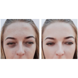 tratamento a laser para acne Jardim Paulista