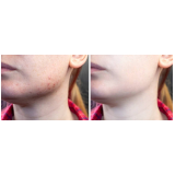 tratamento de acne agendar Jardim Paulista