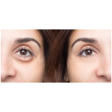 tratamento de preenchimento das olheiras Higienópolis