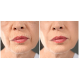 tratamento de preenchimento labial Saúde