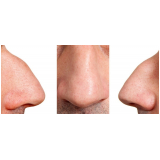 tratamento de preenchimento nariz Saúde
