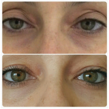 tratamento de preenchimento olheiras Ana Rosa