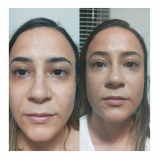 tratamento de rejuvenescimento natural preço Bela Cintra