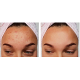 tratamento para acne e manchas agendar Saúde