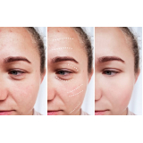 tratamento para acne e manchas Chácara Klabin