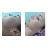 tratamento para acne hormonal Ana Rosa