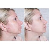 tratamento para manchas de acne Ana Rosa