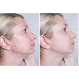 tratamento para manchas de acne Saúde