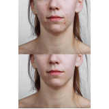 tratamento para marcas de acne Higienópolis
