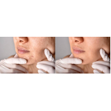 tratamento para os poros da pele Saúde