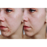 tratamentos acne comprimidos Higienópolis