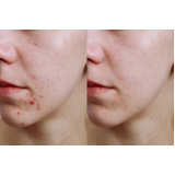 tratamentos para cicatriz de acne Bela Vista